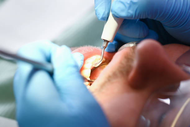 Best Broken or Chipped Tooth Repair in Cedar Ridge, CA